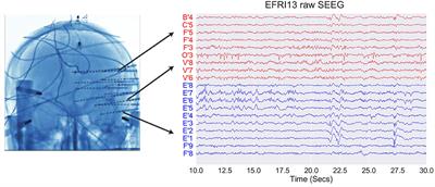 Classification of Stereo-EEG Contacts in White Matter vs. Gray Matter Using Recorded Activity